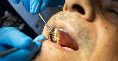 Periodontoloji Nedir? | Düzce diş kliniği | İmge Dental